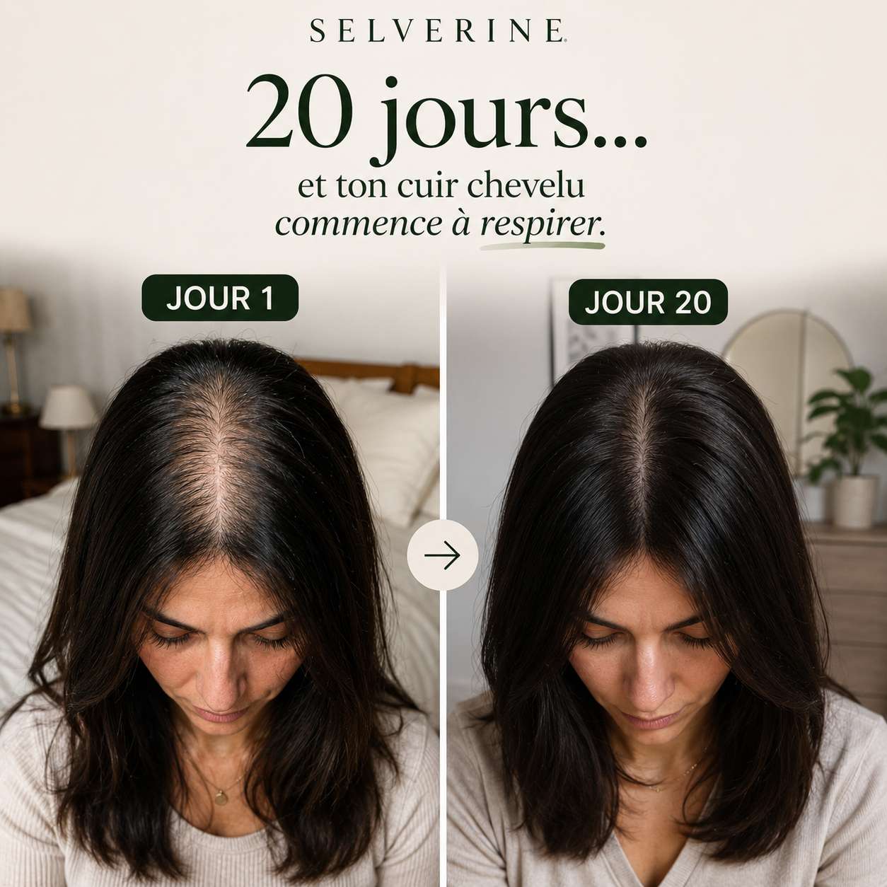 Avant / Après SELVERINE — Jour 1 vs Jour 20